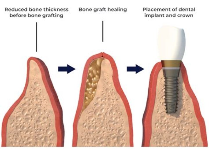 Which bone is used for bone grafting?