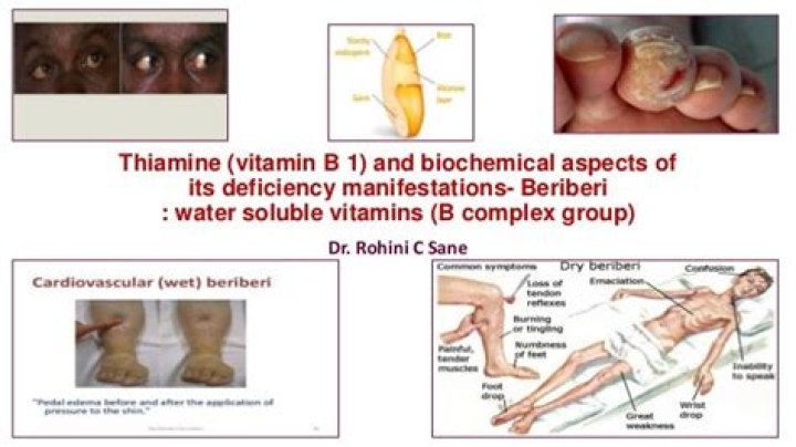 Which deficiency disease is caused by lack of vitamin B1?