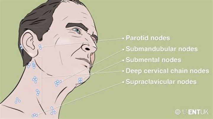 Which disease is likely to cause enlarged lymph nodes under the jaw?