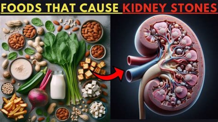 Which nuts can cause kidney stones?