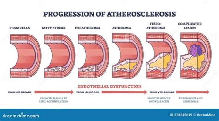 Which of the following initiates the process of atherosclerosis?