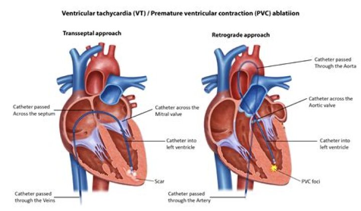 Who needs an ablation?