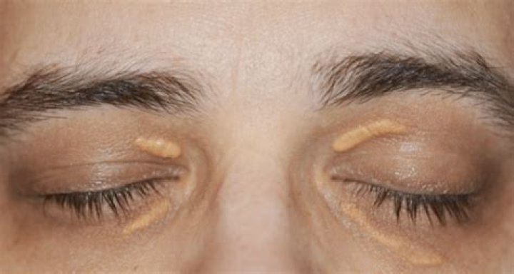 Why are my eyelids pale?