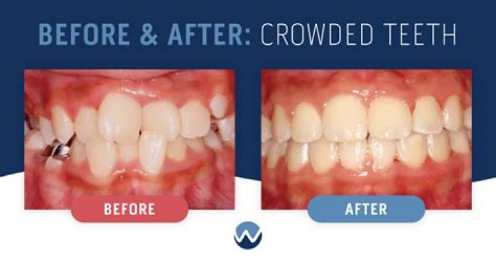 Why are my front teeth crowding?
