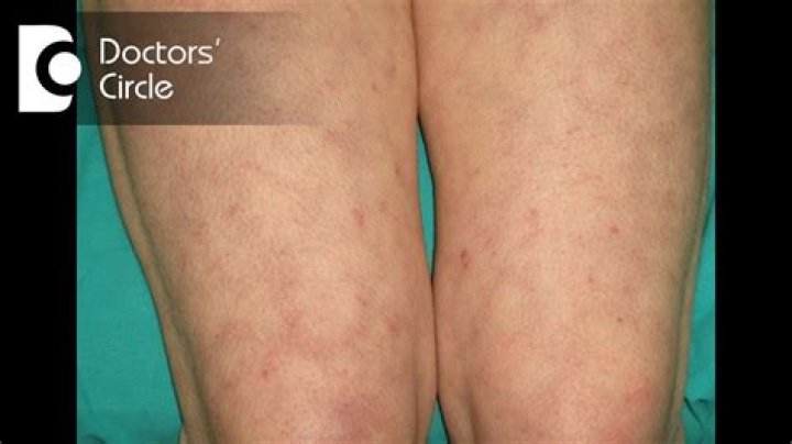 Why are my thighs turning purple?