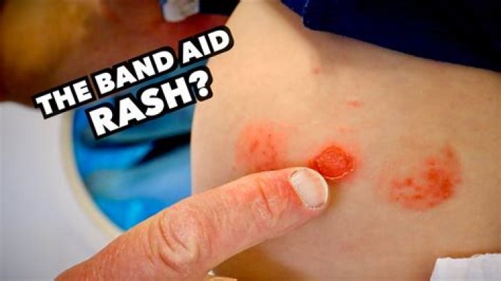 Why do bandaids hurt my skin?