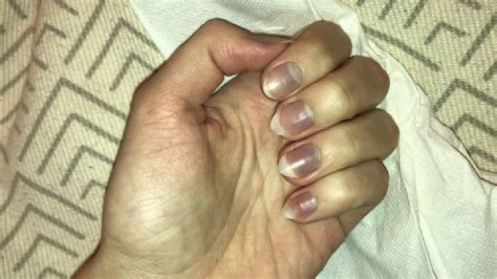 Why do fingernails turn gray?