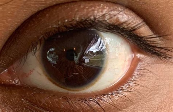 Why do I have a brown ring around my pupil?