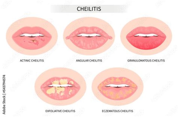 Why do I have itchy bumps around my mouth?