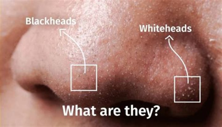 Why do I wake up with Whiteheads?
