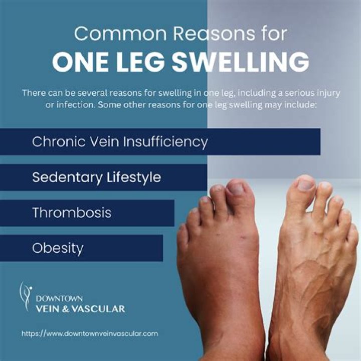 Why do my legs swell when I sit for a long time?