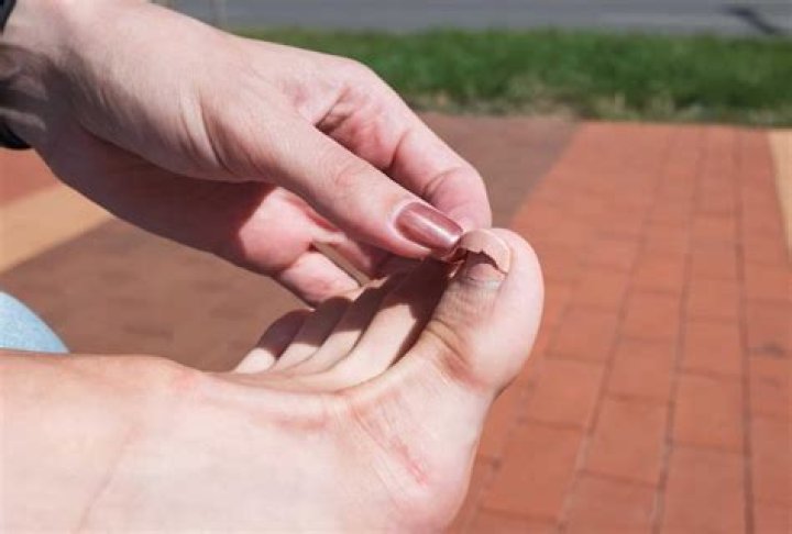 Why do my toenails have cracks?