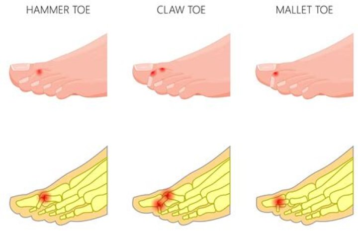 Why do my toes cramp when I curl?