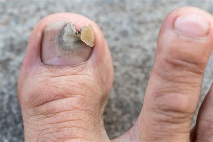 Why does my toenail hurt when I run?
