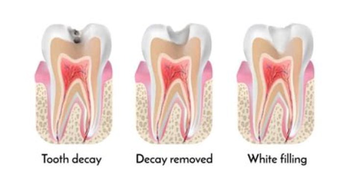Why does my tooth filling keep falling out?
