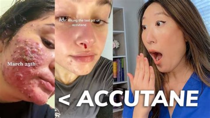 Why is Accutane discontinued?