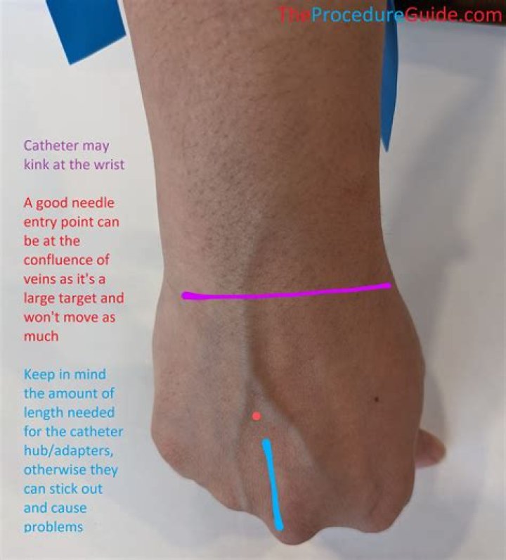 Why is IV access important?