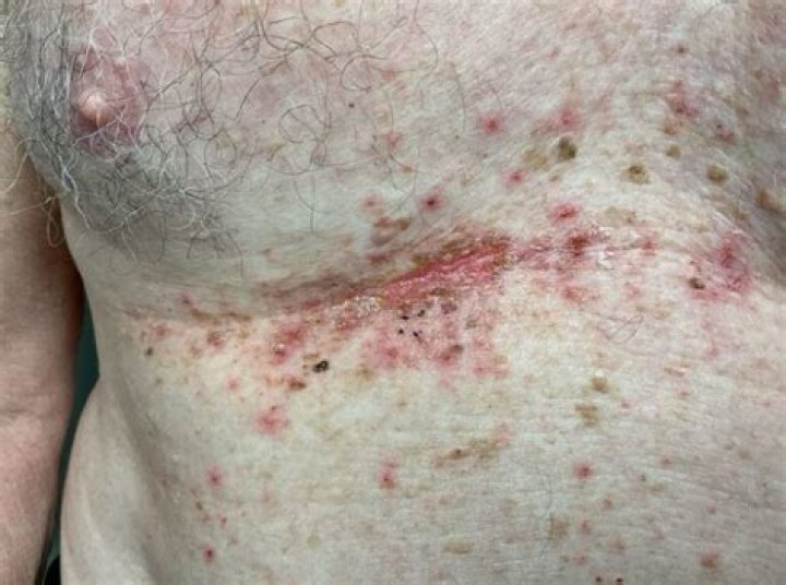 Why is my chest burning and itching?