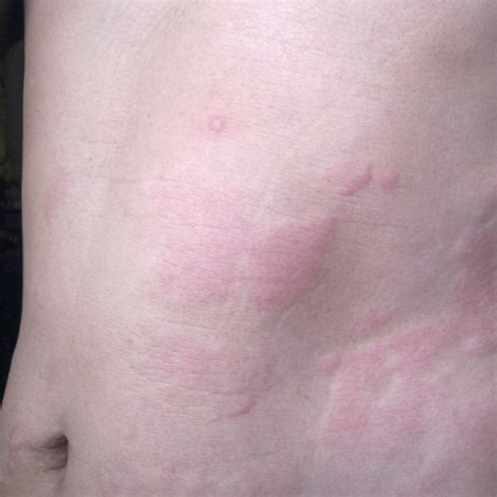 Why is my skin so itchy with no rash?
