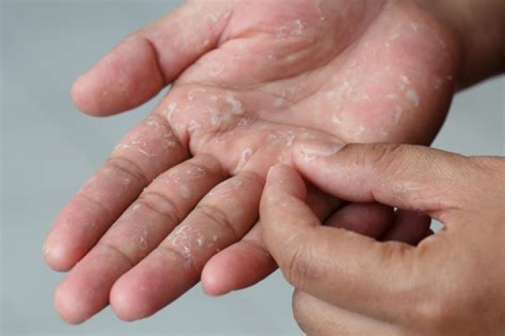 Why is my skin still red after peeling?