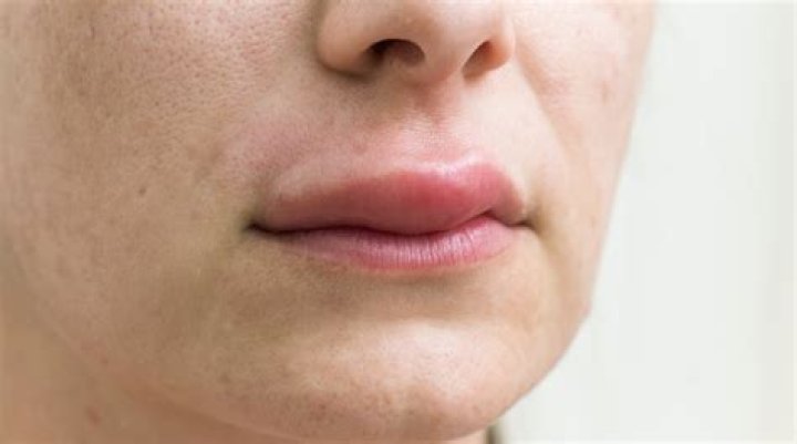 Why is the left side of my bottom lip swollen?