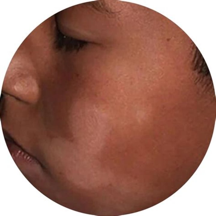Why is there a white spot in my nose?