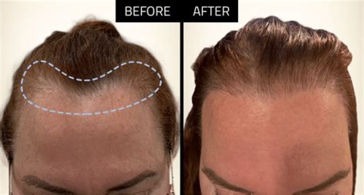 Why transplanted hairs are curly?