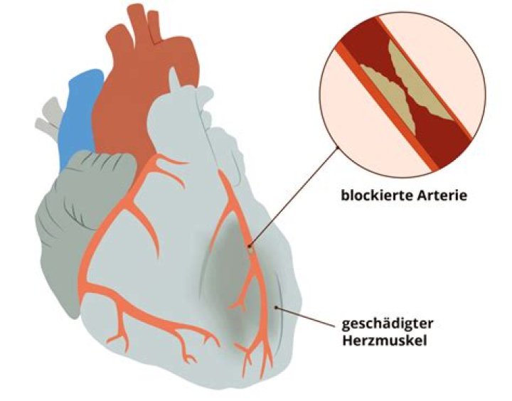 Wie hoch ist die Wahrscheinlichkeit einen Herzinfarkt zu bekommen?