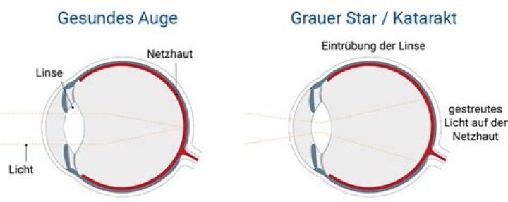 Wie kann man den grauen Star behandeln?