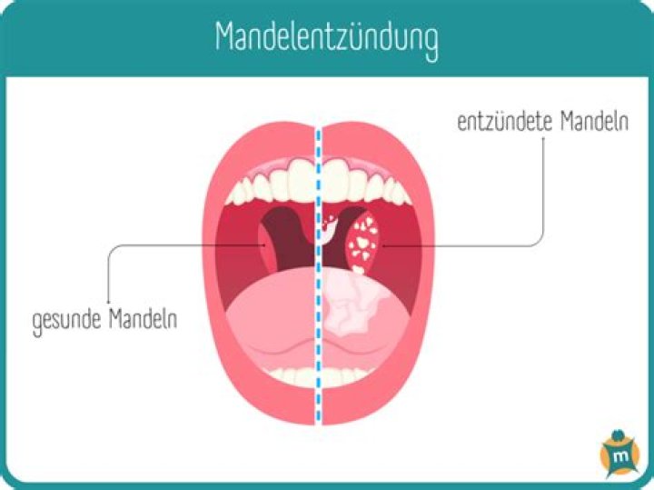 Wie lange dauert eine Angina an?
