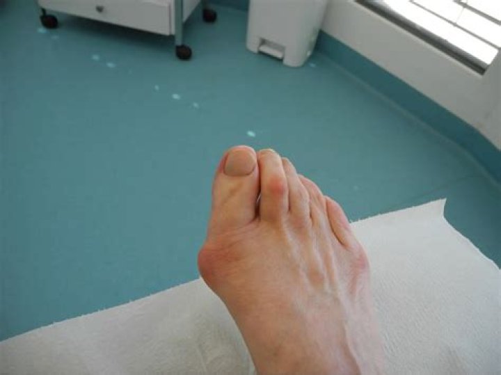 Wie lange muss ich die Thrombose Spritzen nehmen nach Hallux valgus OP?
