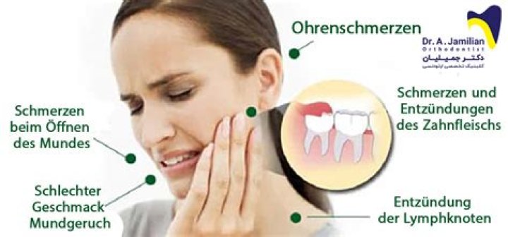 Wie lange Schmerzen nach ziehen Backenzahn?