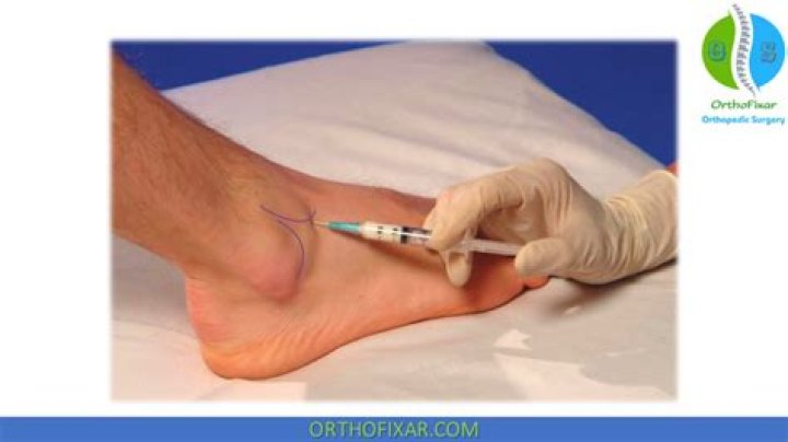 Will a cortisone shot Help ankle tendonitis?