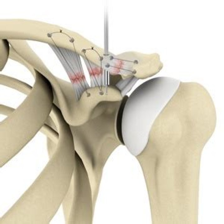 Will AC joint heal its own?