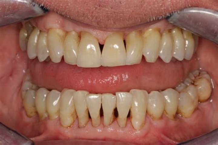 Will gum recession make my teeth fall out?