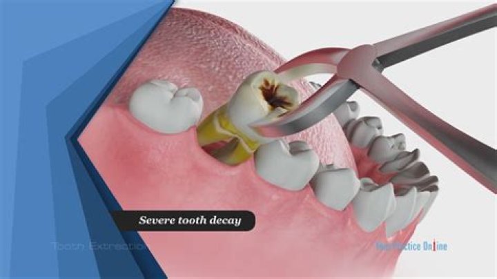 Will my teeth move if I get a molar pulled?