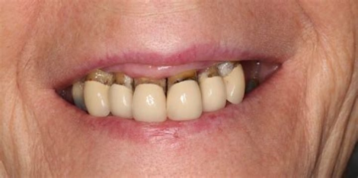 Will peroxide hurt dentures?