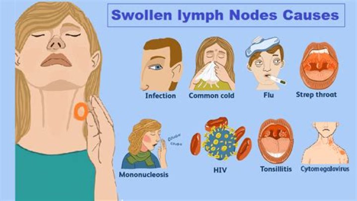 Will steroids shrink swollen lymph nodes?
